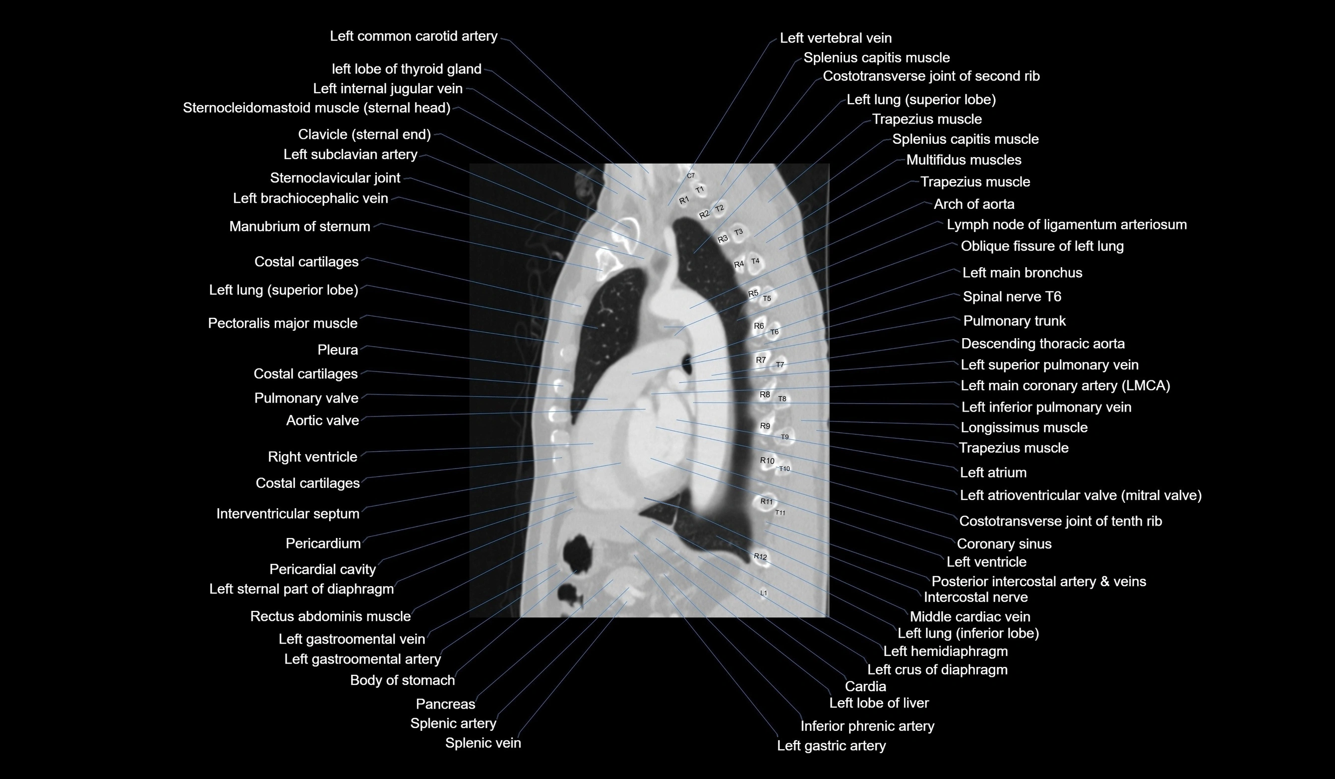 CT chest (thorax) labelled sagittal cross sectional anatomy radiology image-00084.webp